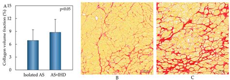 15 mf lv|Histologically Validated Myocardial Fibrosis in Relation to Left .